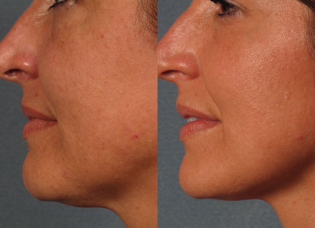 Ultrasound vs RF: Choosing the Best At-Home Skin Tightening